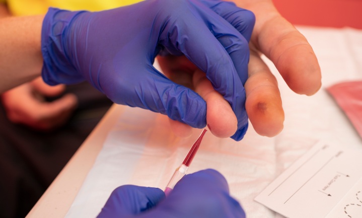 Imagen: la prueba de sangre POC mediante punción digital permite realizar pruebas de ADN de la hepatitis B más rápidamente fuera de los laboratorios centralizados (fotografía cortesía de Conor Ashleigh)