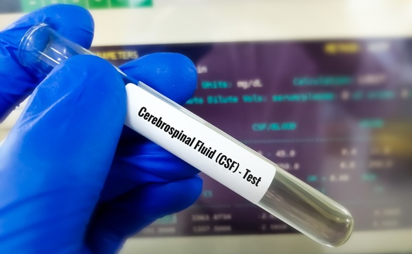 Imagen: el ensayo evalúa el ácido nucleico total derivado de tumores extraído del LCR y detecta múltiples clases de biomarcadores (fotografía cortesía de Shutterstock)