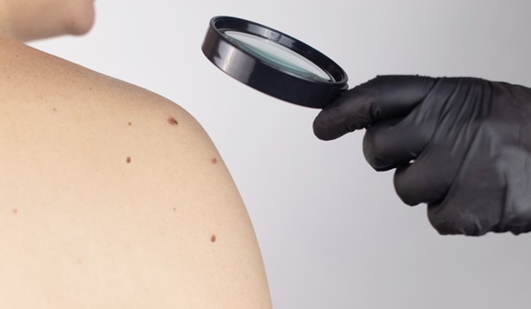 Imagen: la tecnología no invasiva tiene como objetivo mejorar los resultados de la detección del melanoma (Fotografía cortesía de 123RF)