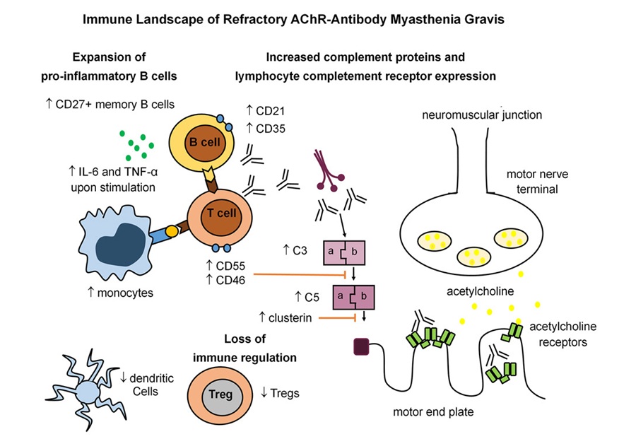 Imagen: el estudio identificó una firma inmune distintiva asociada con la miastenia gravis resistente al tratamiento (Dodd, Katherine C. et al., Med (2026). DOI: 10.1016/j.medj.2025.100987)