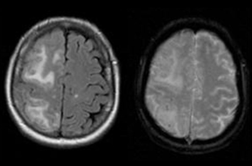 Imagen: ARIA puede manifestarse como inflamación cerebral o pequeñas hemorragias en las resonancias magnéticas, y sigue siendo difícil de predecir antes de iniciar el tratamiento (Reisa A, Sperling et al, via Wikimedia Commons, CC BY 4.0)