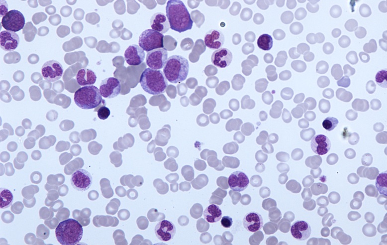 Imagen: La leucemia mielomonocítica crónica (LMMC) es un cáncer de sangre poco común provocado por mutaciones adquiridas en las células madre de la médula ósea (Fotografía cortesía de Simon Caulton/Wikimedia Commons/CC BY-SA 3.0)