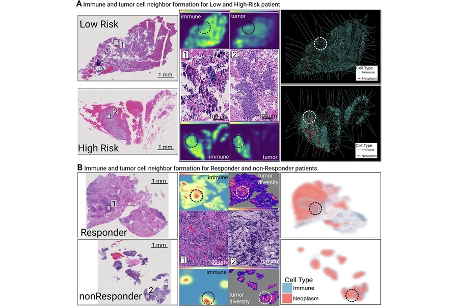 Imagen: Caracterización espacial de las interacciones inmuno-tumorales y la respuesta al tratamiento en modelos de CPCP y de fenotipo extendido (Cristian Barrera et al, npj Precision Oncology (2026). DOI: 10.1038/s41698-025-01225-9)