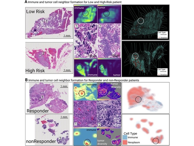 Imagen: Caracterización espacial de las interacciones inmuno-tumorales y la respuesta al tratamiento en modelos de CPCP y de fenotipo extendido (Cristian Barrera et al, npj Precision Oncology (2026). DOI: 10.1038/s41698-025-01225-9)