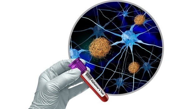 Imagen: la prueba de pTau217 en plasma puede predecir la futura acumulación de amiloide y el deterioro cognitivo en adultos mayores cognitivamente sanos (fotografía cortesía de Shutterstock)