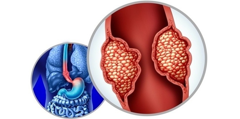 Imagen: Nuevos hallazgos proporcionan pruebas sólidas de que el esófago de Barrett inicia el adenocarcinoma de esófago e identifican marcadores para una detección más temprana (fotografía cortesía de Shutterstock)