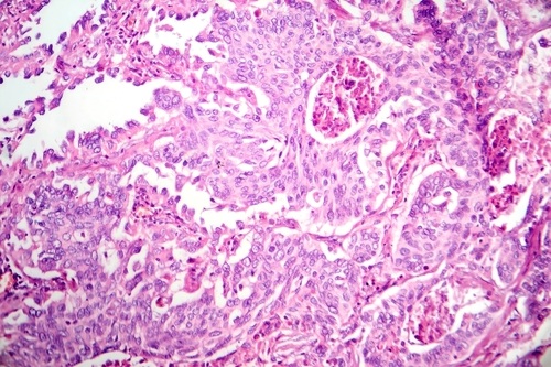 Imagen: el modelo analiza rutinariamente las láminas de patología recolectadas para detectar características tisulares complejas asociadas con la respuesta a la inmunoterapia en el CPNM metastásico (fotografía cortesía de Shutterstock)