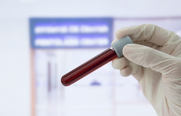 Imagen: EasyM es una prueba de sangre altamente sensible que rastrea un biomarcador de mieloma llamado proteína M (crédito de la foto: 123RF)