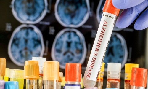Imagen: El análisis de sangre Elecsys pTau217 de Roche, con marca CE, es un análisis de sangre de un solo ensayo que mide la tau 217 fosforilada, un indicador de patología amiloide y un sello distintivo de la enfermedad de Alzheimer (crédito de la imagen: Shutterstock)