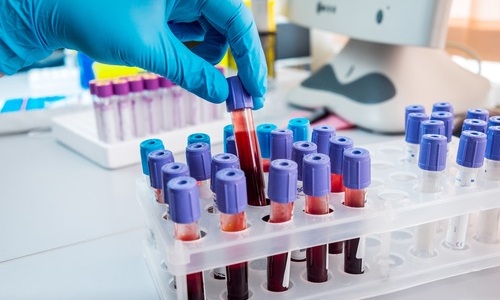 Image: la combinación de factores genéticos con marcadores de envejecimiento biológico podría permitir que un simple análisis de sangre identifique el riesgo de demencia antes de que surjan los síntomas (fotografía cortesía de Shutterstock)