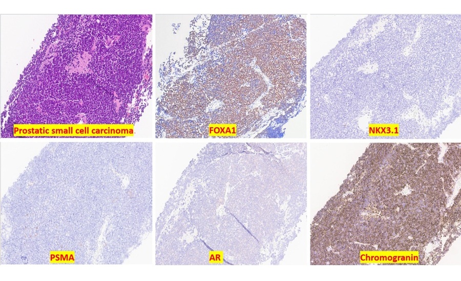 Imagen: FOXA1 es un marcador de diagnóstico altamente sensible para el cáncer de próstata, incluido el carcinoma de células pequeñas de próstata  (Zhao, J., Yao, J., Hosseini, H., et al. Histopathology (2026). doi.org/10.1111/his.70166)