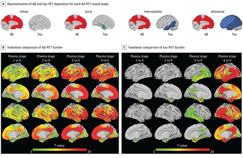 Imagen: Modelos representacionales de depósito regional de Aβ y Tau en etapas plasmáticas (Salvadó G, Horie K, Barthélemy NR, et al. JAMA Neurology. doi:10.1001/jamaneurol.2026.1405)