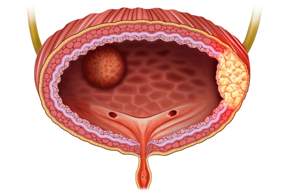 Imagen: El perfil espacial del cáncer de vejiga con invasión muscular revela cómo se organizan los distintos estados de las células tumorales dentro de tumores individuales (Crédito de la imagen: Shutterstock)