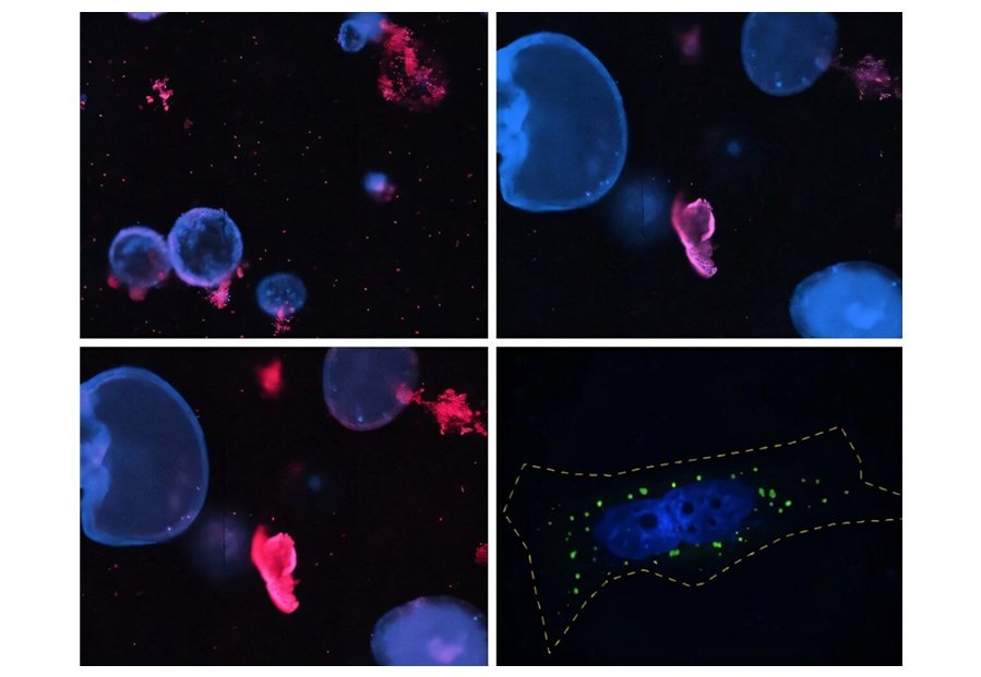 Imagen: El azul representa los núcleos y el rosa representa las células muertas o moribundas. Abajo a la derecha: las células sobreexpresan la variante BIRC3, que se ve en verde. (Foto cortesía de The Hospital for Sick Children)