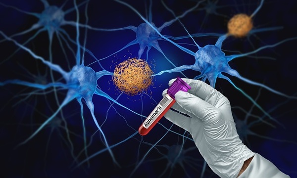 Imagen: La tau 217 fosforilada es una proteína tau modificada relacionada con el deterioro cognitivo en la enfermedad de Alzheimer y fuertemente asociada con la beta amiloide (Fotografía cortesía de Adobe Stock)