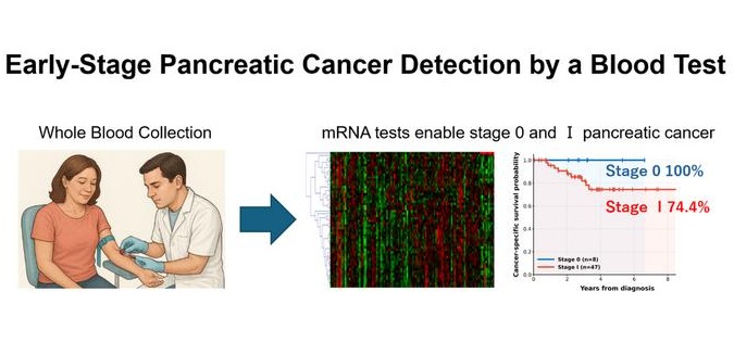 Imagen: Detección de cáncer de páncreas en fase inicial mediante un análisis de sangre. Hacia el desarrollo de un sistema de diagnóstico para el cáncer de páncreas en fase inicial: una prueba de expresión génica no invasiva basada en muestras de sangre permite detectar el cáncer de páncreas en estadio 0 (tasa de supervivencia a 5 años: 100 % en el Hospital Universitario de Kanazawa) y en estadio I (tasa de supervivencia a 5 años: 74,4 %). (Fotografía cortesía de la Universidad de Kanazawa)