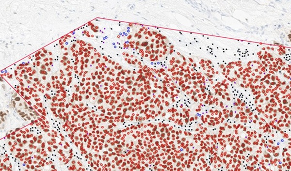 Imagen: El conjunto de mamas, que cubre biopsias y escisiones, proporciona un flujo de trabajo de extremo a extremo totalmente certificado por IVDR en imágenes de portaobjetos completos teñidas con H&E, HER2, ER, PR y Ki67 (Fotografía cortesía de Ibex Medical Analytics)