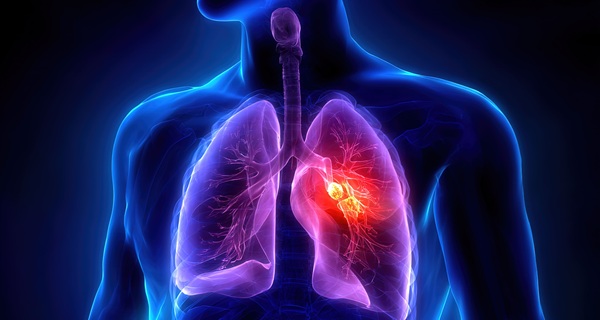 Imagen: Alrededor de 14,2 millones de estadounidenses son elegibles para realizarse pruebas de detección anuales de cáncer de pulmón, pero la aceptación sigue siendo baja y persisten los falsos positivos de la LDCT; CIZ1B puede mejorar la estratificación del riesgo y reducir la incertidumbre (Crédito de la imagen: Adobe Stock)