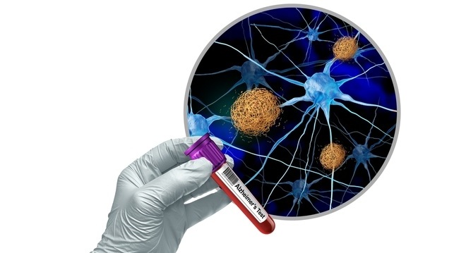 Imagen: El algoritmo de detección incorpora dos biomarcadores plasmáticos: proporción de beta-amiloide y p-tau217, que juntos ayudan a indicar la carga de amiloide en el cerebro (Crédito de la imagen: Shutterstock)