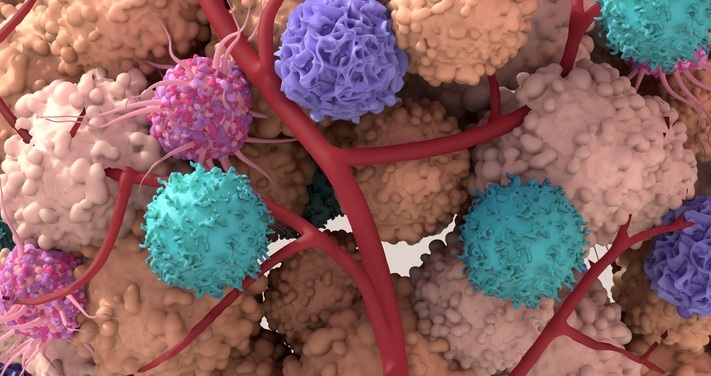 Imagen: Un nuevo estudio demuestra que las características vasculares en los tumores colorrectales podrían servir como biomarcadores pronósticos del resultado de la enfermedad. (Crédito de la imagen: iStock)