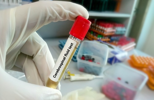 Imagen: El flujo de trabajo propuesto agrega biopsia líquida para detectar signos genéticos y moleculares de cáncer en muestras de LCR ya recolectadas durante la evaluación de la encefalitis autoinmune. (Crédito de la imagen: Shutterstock)