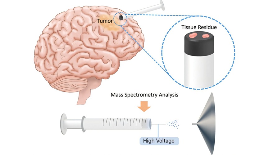 Imagen: Los márgenes del cáncer de cerebro pueden ser especialmente difíciles de mapear. Utilizando espectrometría de masas, investigadores de la Universidad Purdue y la Clínica Mayo pueden mapear los márgenes del tejido resecado en una medición de tres minutos, como se ve en la ilustración. (Crédito de la imagen: Mahdiyeh Shahi/Universidad Purdue)