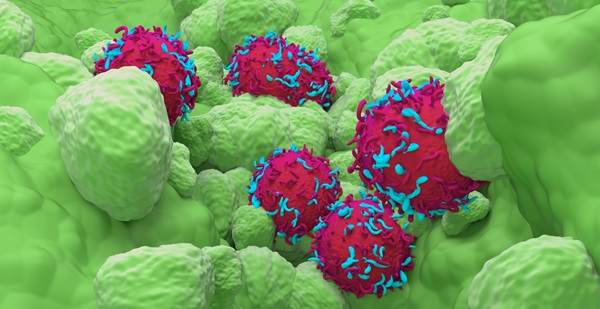 Imagen: La prueba combina señales de ARN del microambiente inmune al tumor para predecir la respuesta al tratamiento, en lugar de depender de un único marcador como la expresión de PD-L1. (Crédito de la imagen: Adobe Stock)