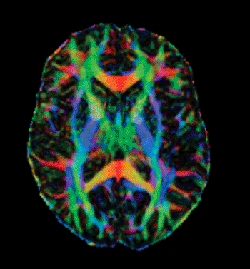 Imagen A: Imágenes de tensor de difusión (DTI) e Imagen de RM (Fotografía cortesía de la RSNA).