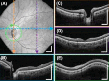 Imagen B: Una imagen OCT de alta definición de la retina les permite a los médicos visualizar de forma no invasiva la estructura 3D de las regiones claves, como la mácula (región cerca de la fóvea) y la cabeza del nervio óptico, para tamizar en busca de signos de patología de enfermedad. Se muestra aquí como una vista de campo amplio (A) y también cortes transversales verticales detallados (B-C-D) y un corte transversal circular (E) (Fotografía cortesía de Biomedical Optics Express.)