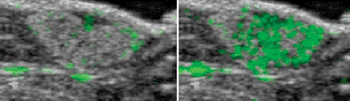 Imagen: Microburbujas SFRP2 enfocadas unidas específicamente a los vasos (teñidos de verde) dentro del angiosarcoma (derecha). Un control sin microburbujas enfocadas (izquierda) (Fotografía cortesía de UNC Health Care).