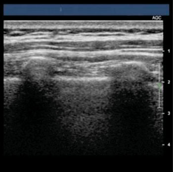 Imagen: Una imagen de ultrasonido de un pulmón (Fotografía cortesía de JP Rathmell).