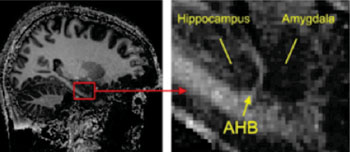 Imagen: El límite entre las regiones importantes del cerebro: el hipocampo y la amígdala es visible en imágenes de resonancia magnética  (RMs) de alta resolución como una  tira brillante, fina (límite amígdala-hipocampo [AHB]) (Fotografía cortesía de AG Ball, Universität Freiburg).