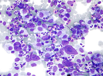 Imagen: Micrografía de linfoma de Hodgkin, muestra de aspiración de aguja fina de ganglio linfático. Coloración de Field (Fotografía cortesía de Wikimedia Commons).