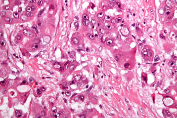 Imagen: Micrografía de muy alto aumento del carcinoma hepatocelular fibrolamelar mostrando la fibrosis laminada característica entre las células tumorales con un índice N/C bajo. Tinción H&E (Fotografía cortesía de Wikimedia Commons).