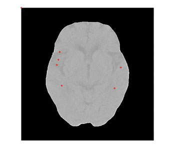 Imagen B: Detección automática de posibles áreas de accidente cerebrovascular isquémico (Fotografía cortesía de la Universidad Politécnica de Hong Kong).