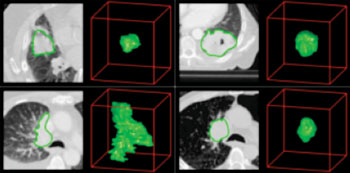 Imagen: Extracción de la información radiómica de los exámenes por TC de pacientes con cáncer de pulmón. Las imágenes de la TC con contornos tumorales a la izquierda y visualizaciones tridimensionales a la derecha (Fotografía cortesía del Centro Médico de la Universidad de Maastricht).