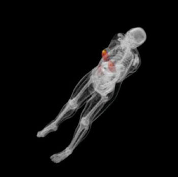 Imagen A: Las mediciones de la mama en tres dimensiones (3D) con dosis simuladas muestran las dosis que recibiría todo el cuerpo. La dosis se muestra en un mapa de color rojo y amarillo, en el cual, se muestra en amarillo la dosis máxima (Fotografía cortesía de Duke Medicine).