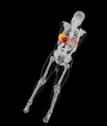 Imagen B: Mediciones de las dosis simuladas para 3D del abdomen y el hígado que muestran las dosis que recibiría todo el cuerpo. La dosis se muestra en un mapa de color rojo y amarillo, en el cual, se muestra en amarillo la dosis máxima (Fotografía cortesía de Duke Medicine).