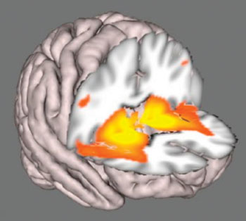 Imagen: La RM revela los cambios ocurridos en el cerebro durante la enfermedad de Parkinson temprana (Fotografía cortesía de la Universidad de Oxford).