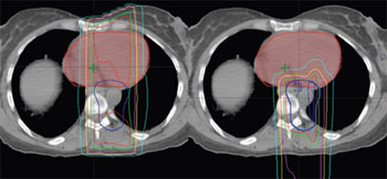 Imagen: Un corte de TC axial a través del corazón (rojo) de un paciente con linfoma de Hodgkin en el mediastino. A la izquierda está el mapa de rayos X y a la derecha el mapa con protones. La línea azul oscura que se muestra en ambos, representa el tumor y el área de destino para la radiación. La línea verde representa el volumen del cuerpo que recibe el 95% de la dosis total de radiación prescrita, mientras que la línea de color azul claro refleja el volumen del cuerpo que recibe el 10% de la dosis de radiación total prescrita. Como es evidente, con radiación convencional (izquierda), los rayos X depositan más radiación en el corazón y los senos que el plan con protones. De hecho, el plan con protones redujo la dosis media que llega al corazón en más de un 50% y la dosis media que llega al seno en un 70%. Por esta razón, se cree que los pacientes con linfoma de Hodgkin tendrán un riesgo mucho menor de sufrir enfermedades cardíacas o un cáncer secundario con el tratamiento con protones que lo que se ha observado en el pasado con la radioterapia convencional (Fotografía cortesía del Instituto para Tratamiento con Protones de la Universidad de Florida).