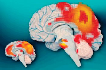 Imagen: Izquierda, los cerebros de los adultos que tuvieron TDAH infantil, pero ya no la tienen, muestran actividad sincrónica entre la corteza cingulada posterior (la región más grande de color rojo) y la corteza prefrontal media (región roja más pequeña). A la derecha, los cerebros de los adultos que continúan padeciendo TDAH no muestran esta actividad sincrónica (Fotografía cortesía de José-Luis Olivares/MIT).