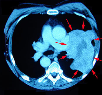 Imagen: Una tomografía computarizada (TC) muestra el cáncer de pulmón (Fotografía cortesía de Kevin Kavanagh, MD).