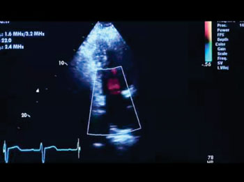 Imagen: El sistema Vivid T8 para ecografía cardiovascular ofrece características cuantitativas, tales como las funciones para eco de esfuerzo y ecocardiografía transesofágica (TEE)  (Fotografía cortesía de GE Healthcare).