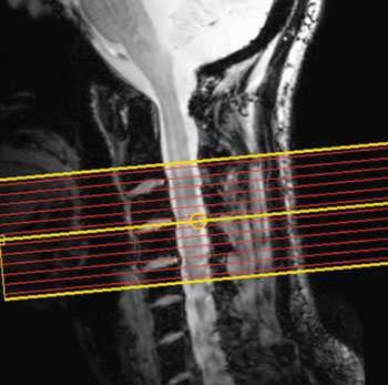 Imagen A: Los niveles de actividad de diferentes partes de la médula espinal de personas en reposo se midieron utilizando fMRI (Fotografía cortesía de Barry RL, Smith SA, Dula AN, et al, revista eLIFE, 5 de agosto de 2014).