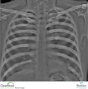 Imagen: Una radiografía obtenida utilizando la tecnología del software ClearRead para supresión ósea (Fotografía cortesía de Riverain Technologies).