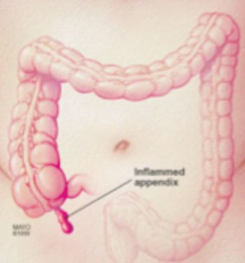 Imagen: Una ilustración de un apéndice inflamado (Fotografía cortesía del Centro Pediátrico de la Clínica Mayo).
