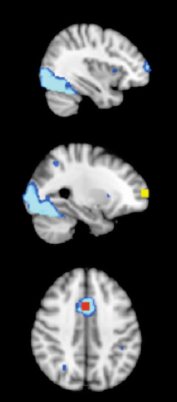 Imagen: Cuadro de 8 mm de diámetro con la región de interés (ROI) de 1.000 mm3 en la corteza frontal, obtenido de un mapa de activación promedio durante las condiciones incongruentes, neutras y NoGo para la habilidad del control cognitivo, en grupos de niños, tanto de control como durante la actividad física en fases previa y posterior a las pruebas (fijación del umbral en Z > 6). Corteza prefrontal anterior derecha = amarillo; ACC = rojo; mapa de activación promedio = azul (Fotografía cortesía de la revista Frontiers in Human Neuroscience).