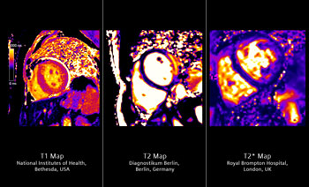 Imagen: La cuantificación T1, T2 y T2 del tejido miocárdico en una sola solución, sobre la marcha. MyoMaps1, basado en la Corrección del Movimiento Inline de HeartFreeze, (exclusiva de Siemens), ofrece la cuantificación miocárdica basada en píxeles. Se pueden detectar mejor las patologías miocárdicas globales y difusas (mapa T1), representar mejor un edema cardíaco (mapa T2), así como mejorar la detección precoz de la sobrecarga de hierro (mapa T2) (Fotografía cortesía de Siemens Healthcare).