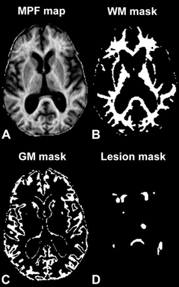 Imagen B: Un ejemplo de corte axial, de un mapa de la MPF tridimensional (A) obtenido de una mujer de 63 años de edad, con la enfermedad de EMRR en desarrollo y resultados de la segmentación del tejido cerebral (B a D). Se utilizaron las máscaras de segmentación correspondientes a: (B) a la sustancia blanca (WM), (C) a la materia gris (GM) y (D) a lesiones para calcular los valores medios de la MPF de cada tejido (Fotografía cortesía de la Sociedad Radiológica de América del Norte).