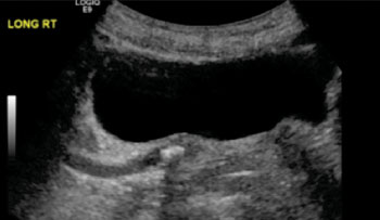 Imagen: Un ultrasonido de la vejiga mostrando un uréter bloqueado por un cálculo renal (Fotografía cortesía de la Universidad de California, San Francisco).